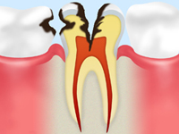 C2 象牙質の虫歯