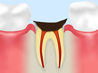 C4 歯根の虫歯