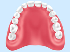 レジン床義歯