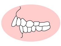 上顎前突（じょうがくぜんとつ）