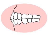 上下顎前突（じょうげがくぜんとつ）