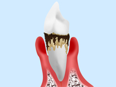 日本では成人の約8割が歯周病患者、もしくは歯周病予備軍!?