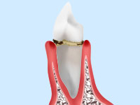 歯肉炎・軽度歯周炎